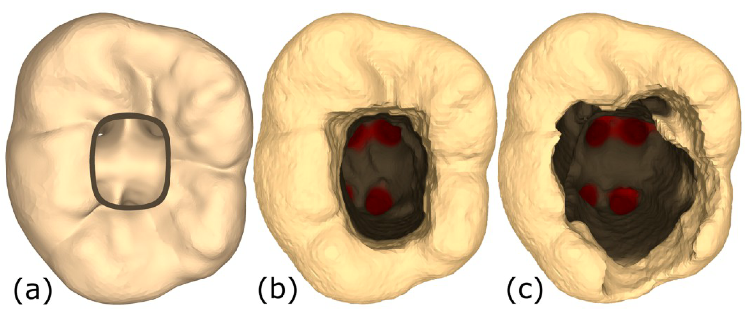 Comparison between three teeth states that could be the outcomes of drilling during root-canal-access opening.