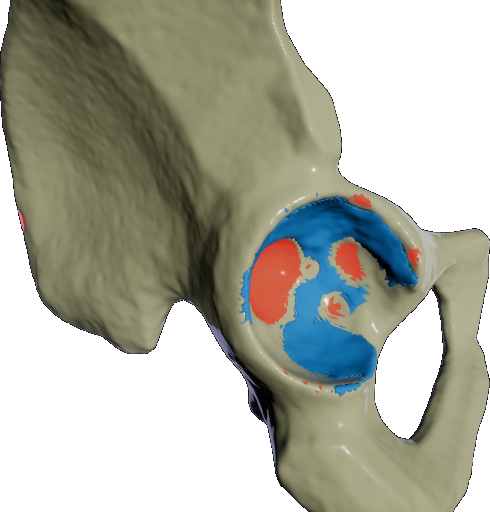 Visualization of a poorly reamed hip socket.