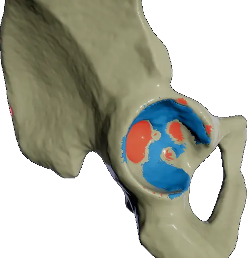 Visualization of a poorly reamed hip socket.