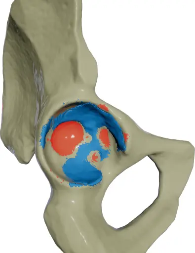 Visualization of a poorly reamed hip socket.
